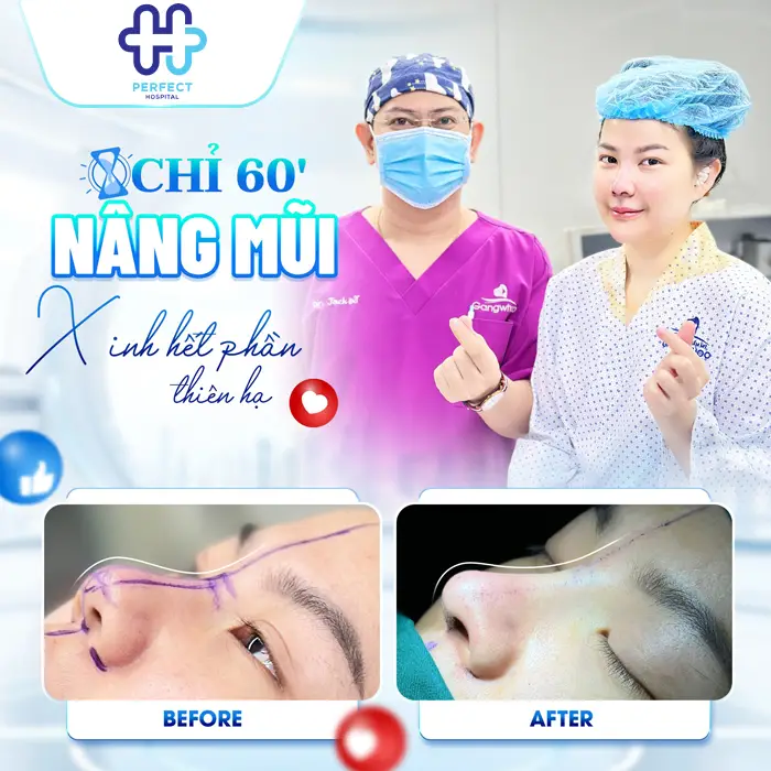 Quá Trình Nâng Mũi Mất Bao Lâu? Yếu Tố Quyết Định Thời Gian Thực Hiện