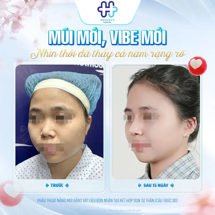 Quá Trình Nâng Mũi Mất Bao Lâu? Yếu Tố Quyết Định Thời Gian Thực Hiện