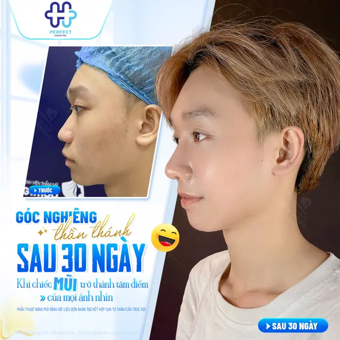 Quá Trình Nâng Mũi Mất Bao Lâu? Yếu Tố Quyết Định Thời Gian Thực Hiện