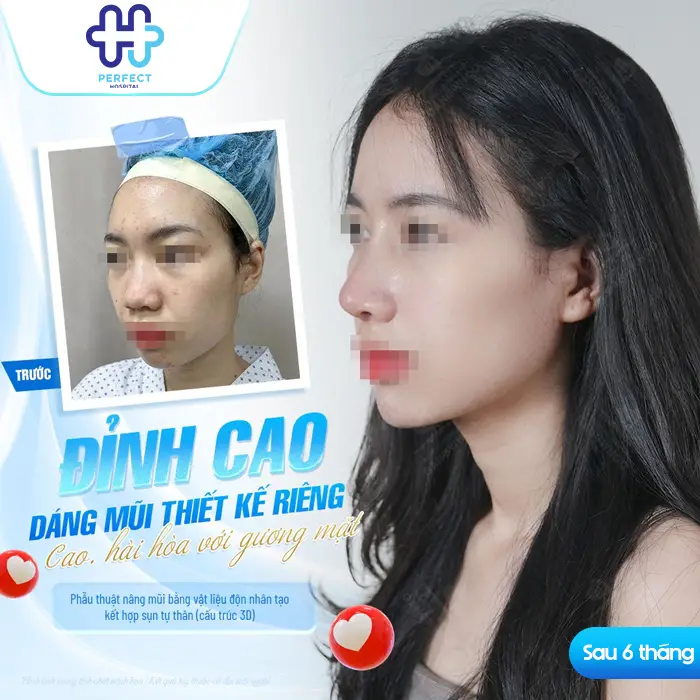 Quá Trình Nâng Mũi Mất Bao Lâu? Yếu Tố Quyết Định Thời Gian Thực Hiện