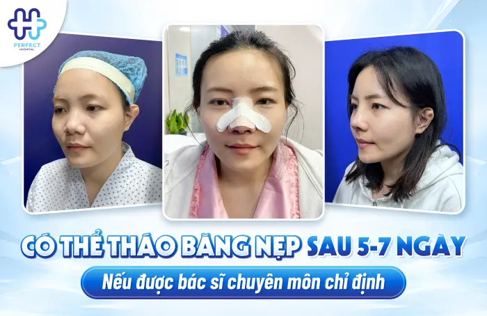 Nâng Mũi Mấy Ngày Tháo Băng? Mốc Thời Gian Hồi Phục Chuẩn