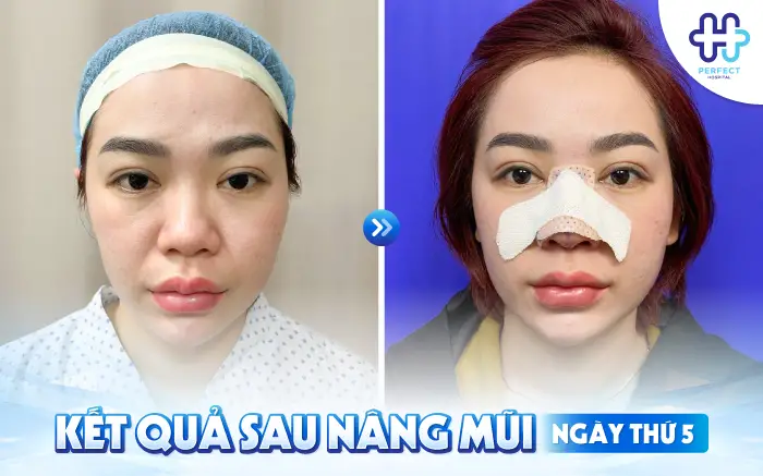 Nâng Mũi Mấy Ngày Tháo Băng? Mốc Thời Gian Hồi Phục Chuẩn