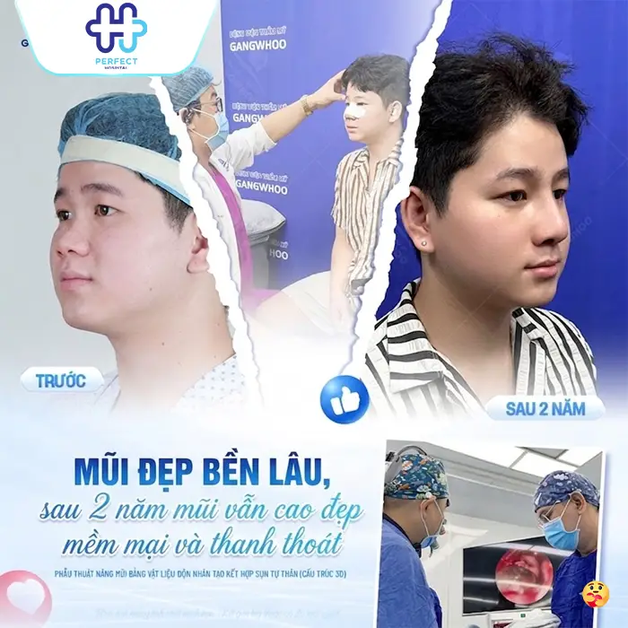 Nâng Mũi Megaderm Được Bao Lâu? Có Duy Trì Lâu Dài Không?