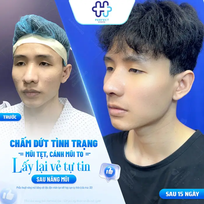Nâng Mũi Megaderm Được Bao Lâu? Có Duy Trì Lâu Dài Không?