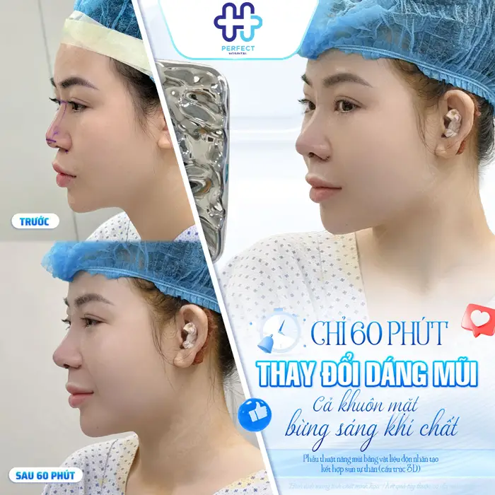 Nâng Mũi Megaderm Được Bao Lâu? Có Duy Trì Lâu Dài Không?
