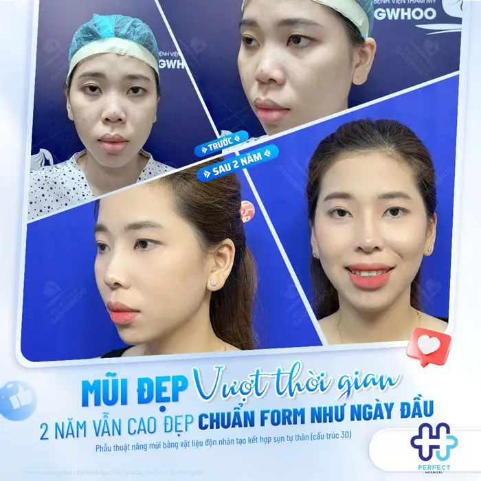 Nâng Mũi Megaderm Được Bao Lâu? Có Duy Trì Lâu Dài Không?