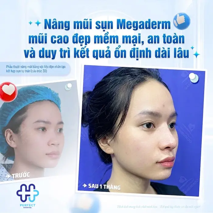 Nâng Mũi Megaderm Được Bao Lâu? Có Duy Trì Lâu Dài Không?