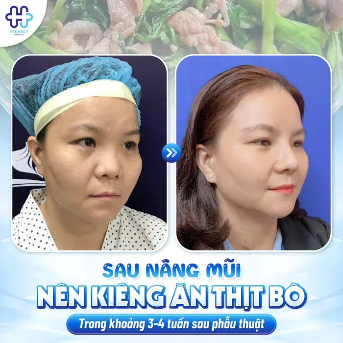 Nâng Mũi Kiêng Thịt Bò Bao Lâu? Thời Điểm Ăn Lại An Toàn