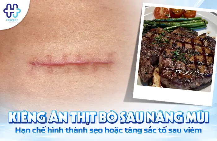 Nâng Mũi Kiêng Thịt Bò Bao Lâu? Thời Điểm Ăn Lại An Toàn