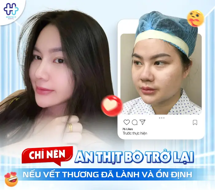 Nâng Mũi Kiêng Thịt Bò Bao Lâu? Thời Điểm Ăn Lại An Toàn