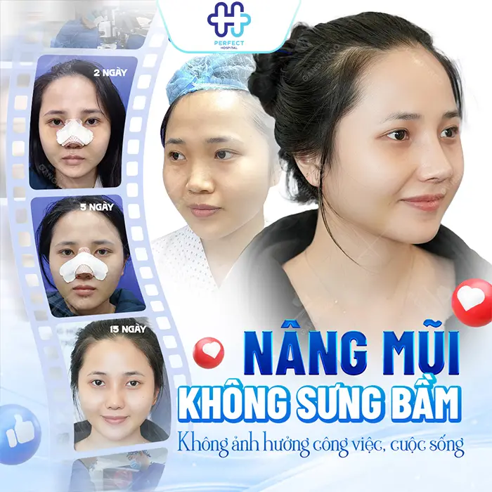 Nâng Mũi Nghỉ Dưỡng Bao Lâu? Khi Nào Có Thể Sinh Hoạt Bình Thường?