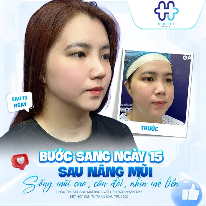 Nâng Mũi Nghỉ Dưỡng Bao Lâu? Khi Nào Có Thể Sinh Hoạt Bình Thường?