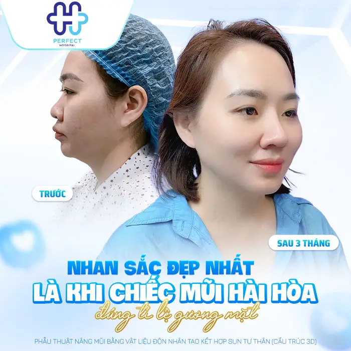 Nâng Mũi Nghỉ Dưỡng Bao Lâu? Khi Nào Có Thể Sinh Hoạt Bình Thường?