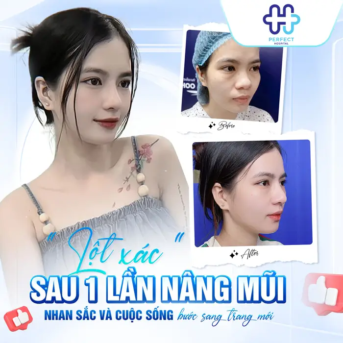 Nâng Mũi S Line Giá Bao Nhiêu? Chi Phí Mới Nhất 2026