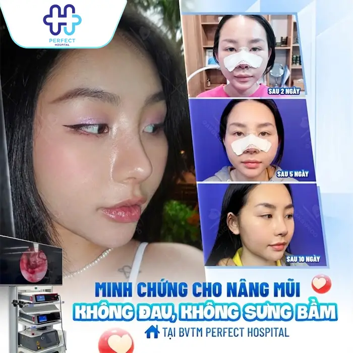 Nâng Mũi S Line Giá Bao Nhiêu? Chi Phí Mới Nhất 2026