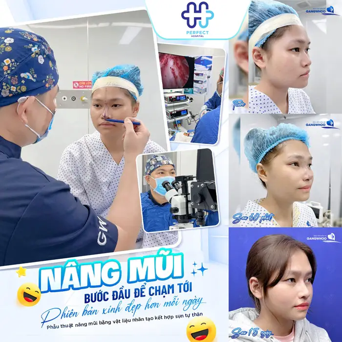 Nâng Mũi S Line Giá Bao Nhiêu? Chi Phí Mới Nhất 2026