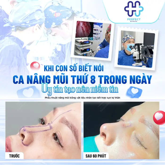Nâng Mũi S Line Giá Bao Nhiêu? Chi Phí Mới Nhất 2026
