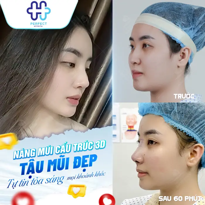 Nâng Mũi S Line Giá Bao Nhiêu? Chi Phí Mới Nhất 2026