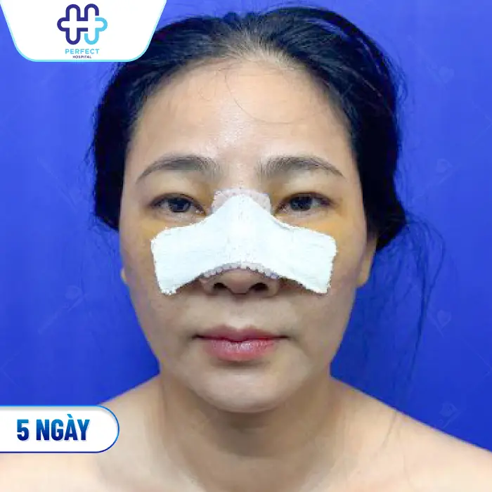 Nâng Mũi Sau 10 Ngày Đã Ổn Định Chưa? Cách Chăm Sóc Đúng