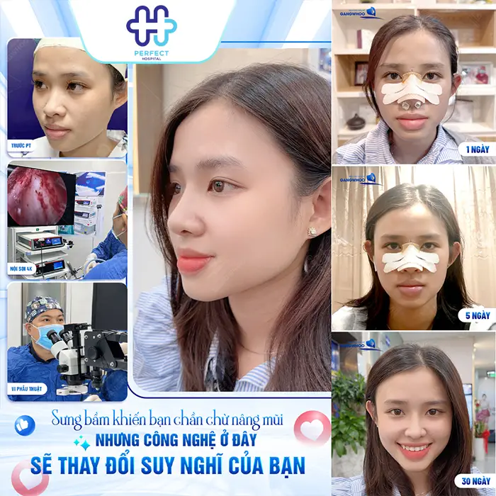 Nâng Mũi Sau 10 Ngày Đã Ổn Định Chưa? Cách Chăm Sóc Đúng