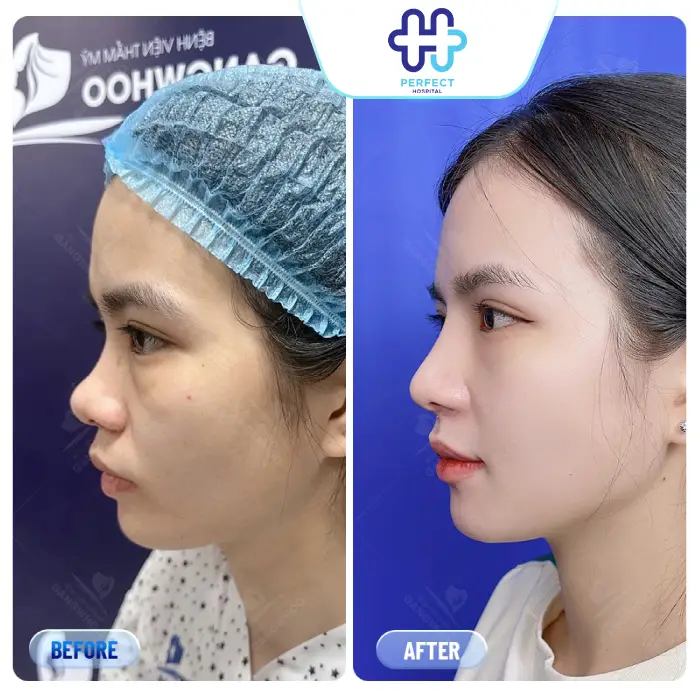 Nâng Mũi Sau 10 Ngày Đã Ổn Định Chưa? Cách Chăm Sóc Đúng