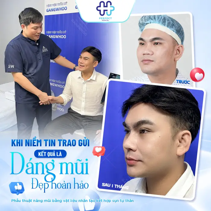 Nâng Mũi Sau 10 Ngày Đã Ổn Định Chưa? Cách Chăm Sóc Đúng