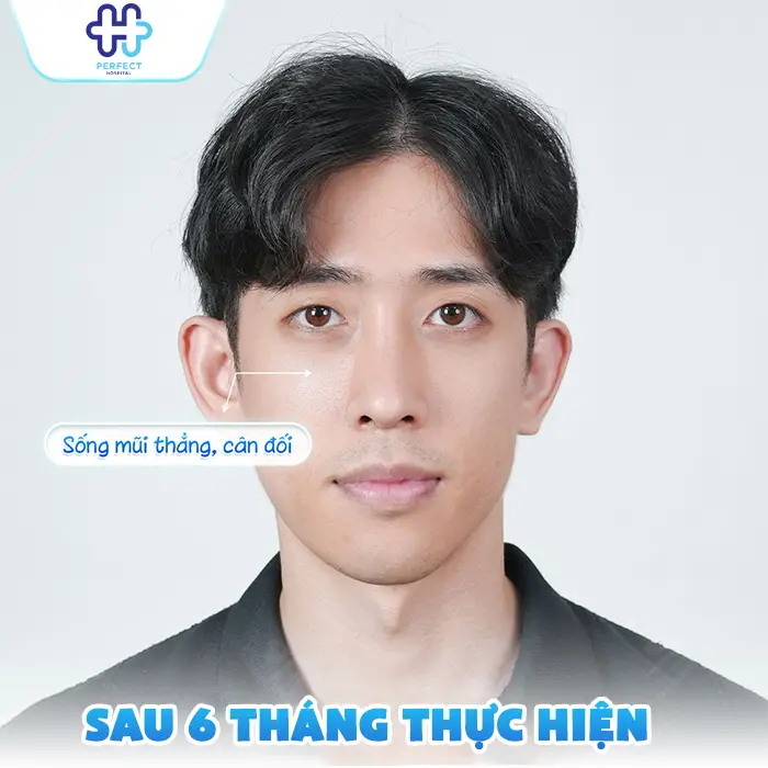 Nâng Mũi Sau 6 Tháng Ổn Định Chưa? Dấu Hiệu Mũi Đẹp Tự Nhiên