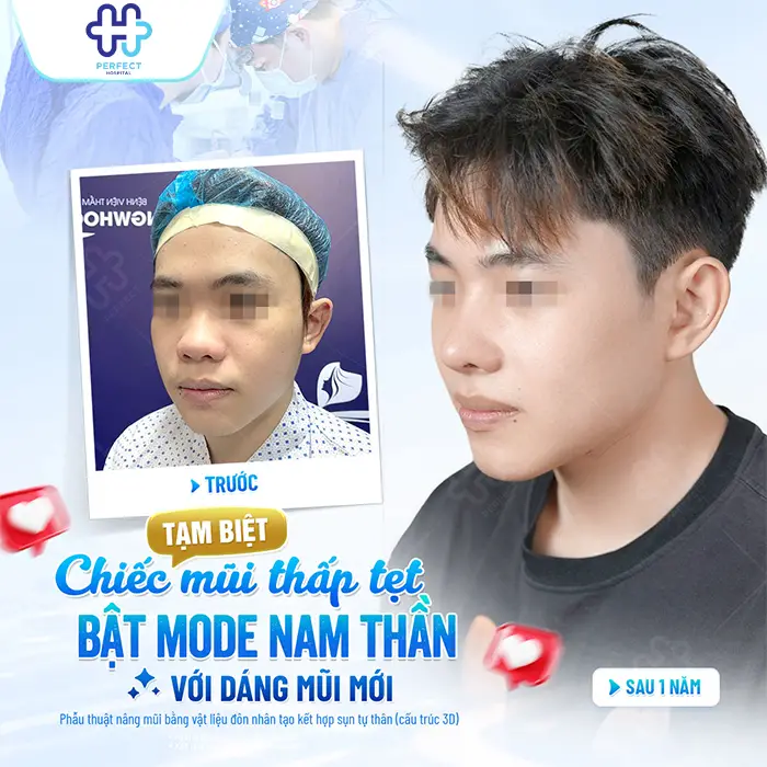 Nâng Mũi Sau 6 Tháng Ổn Định Chưa? Dấu Hiệu Mũi Đẹp Tự Nhiên