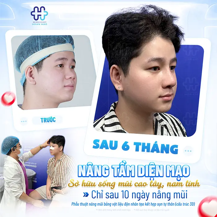 Nâng Mũi Sau 6 Tháng Ổn Định Chưa? Dấu Hiệu Mũi Đẹp Tự Nhiên