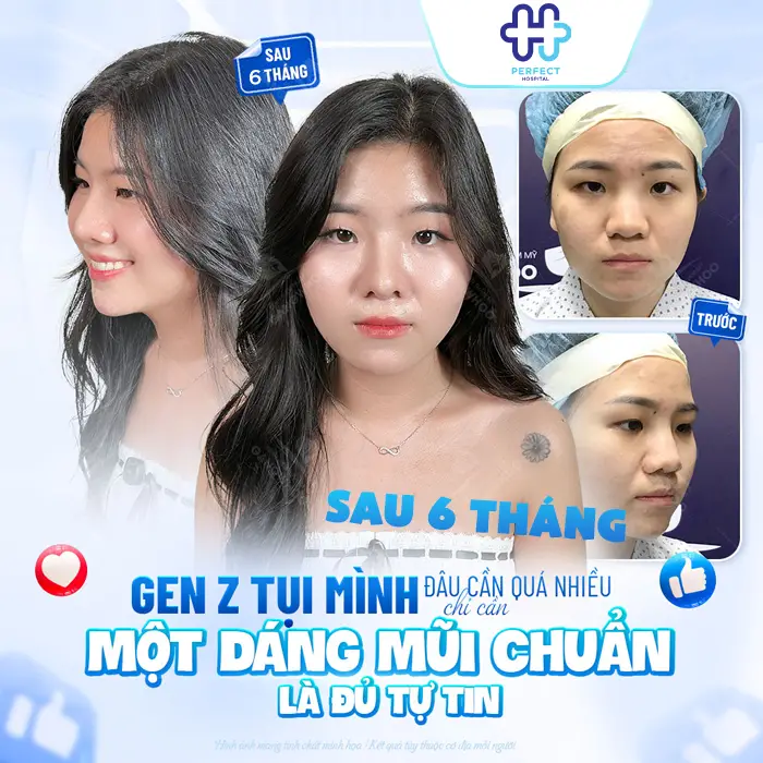 Nâng Mũi Sau 6 Tháng Ổn Định Chưa? Dấu Hiệu Mũi Đẹp Tự Nhiên