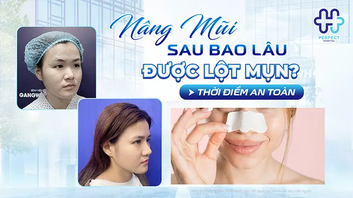Nâng Mũi Sau Bao Lâu Thì Được Lột Mụn? Thời Điểm An Toàn