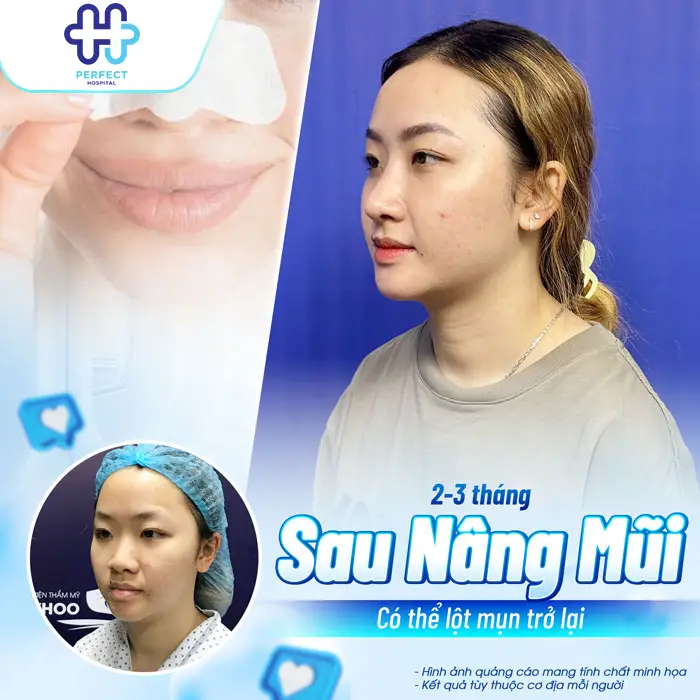 Nâng Mũi Sau Bao Lâu Thì Được Lột Mụn? Thời Điểm An Toàn