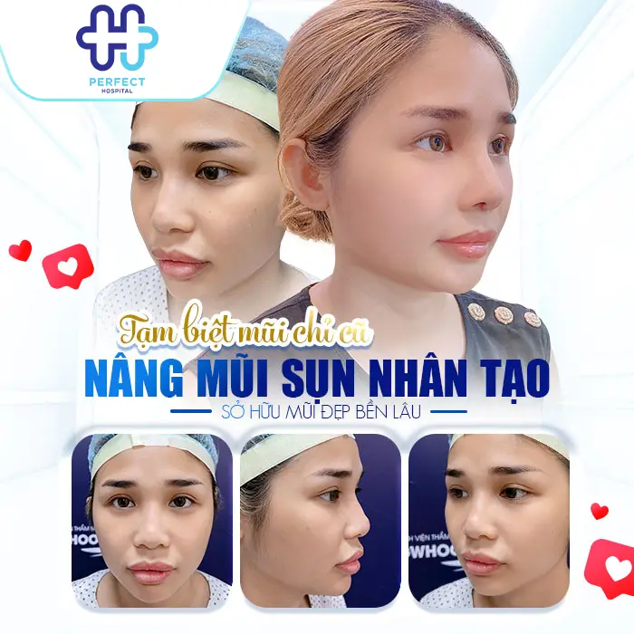 Nâng Mũi Sụn Nhân Tạo Là Gì? Có An Toàn Và Bền Lâu Không?