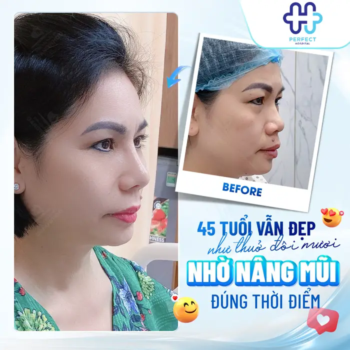 Nâng Mũi Sụn Nhân Tạo Là Gì? Có An Toàn Và Bền Lâu Không?