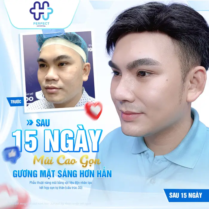 Nâng Mũi Sụn Nhân Tạo Là Gì? Có An Toàn Và Bền Lâu Không?