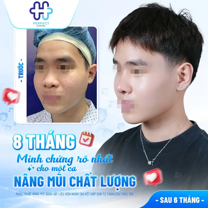 Nâng Mũi Sụn Nhân Tạo Là Gì? Có An Toàn Và Bền Lâu Không?