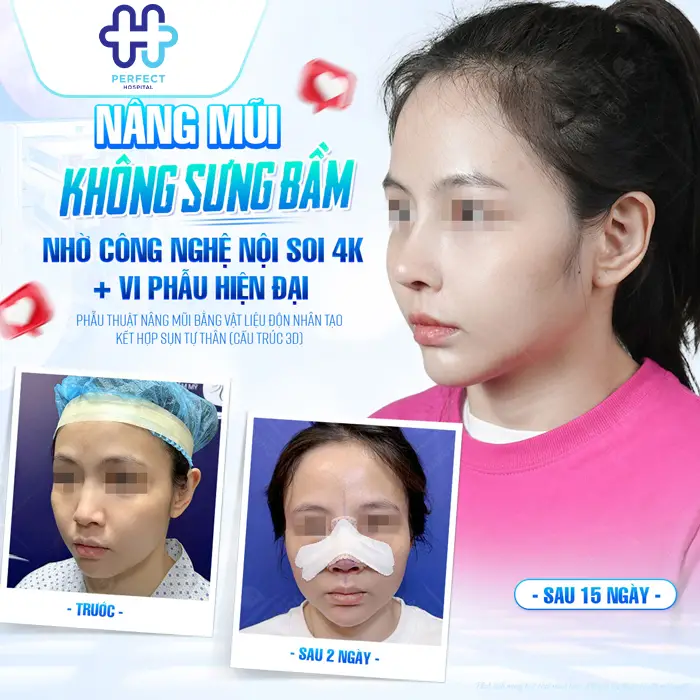 Nâng Mũi Sụn Nhân Tạo Là Gì? Có An Toàn Và Bền Lâu Không?