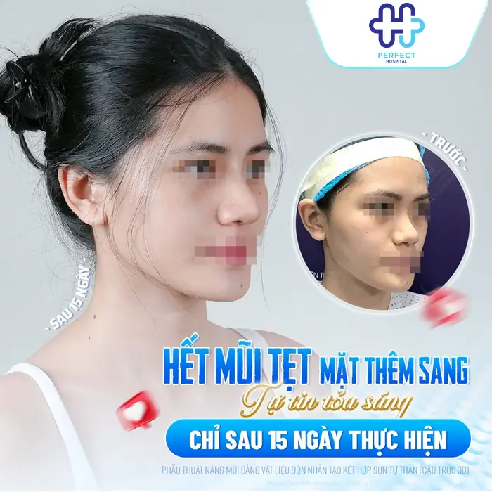 Nâng Mũi Sụn Nhân Tạo Là Gì? Có An Toàn Và Bền Lâu Không?