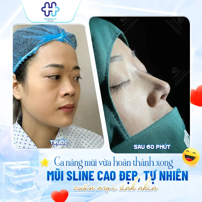 Nâng Mũi Sụn Tai Có Vĩnh Viễn Không? Giải Đáp Chi Tiết
