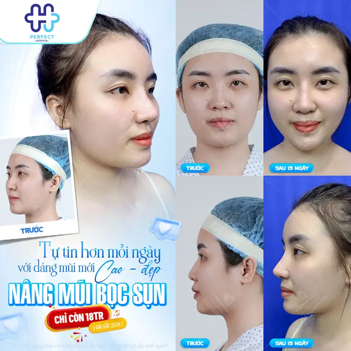 Nâng Mũi Sụn Tai Có Vĩnh Viễn Không? Giải Đáp Chi Tiết
