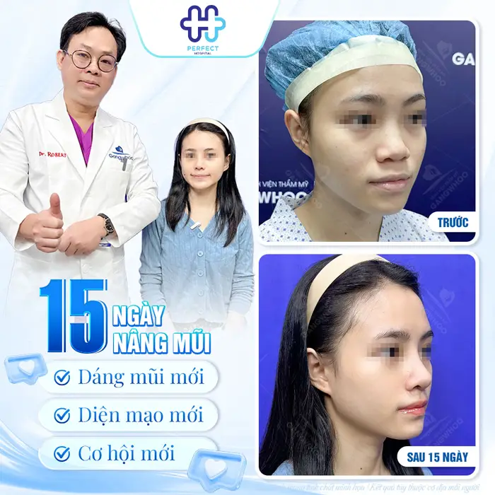 Nâng Mũi Sụn Tai Có Vĩnh Viễn Không? Giải Đáp Chi Tiết