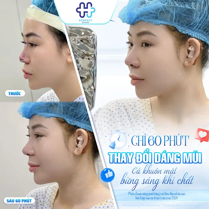 Nâng Mũi Sụn Tai Có Vĩnh Viễn Không? Giải Đáp Chi Tiết