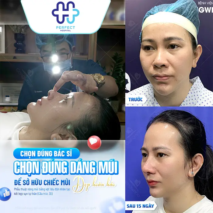 Nâng Mũi Sụn Tai Giá Bao Nhiêu? Chi Phí Mới Nhất Hiện Nay
