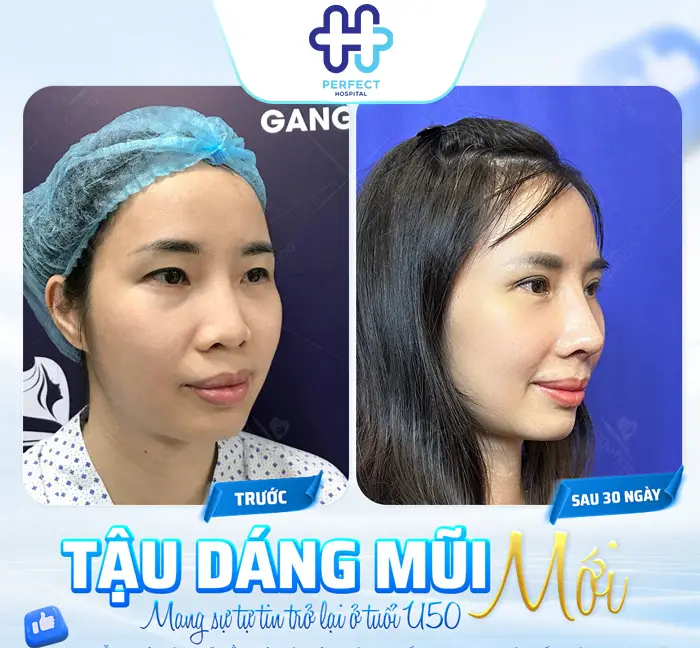 Nâng Mũi Sụn Tai Giá Bao Nhiêu? Chi Phí Mới Nhất Hiện Nay