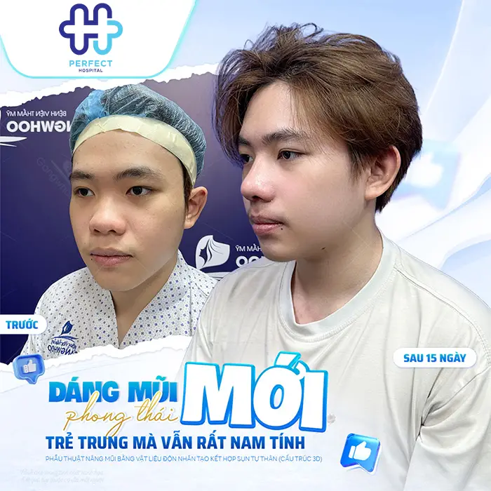 Nâng Mũi Sụn Tai Giá Bao Nhiêu? Chi Phí Mới Nhất Hiện Nay