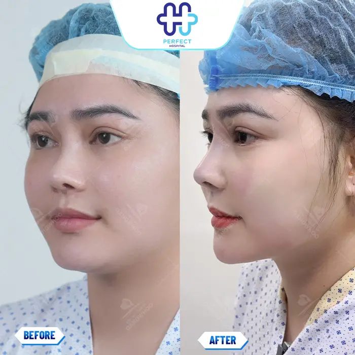 Nâng Mũi Sụn Tự Thân Là Gì? Có Tốt Không Và Quy Trình Ra Sao?