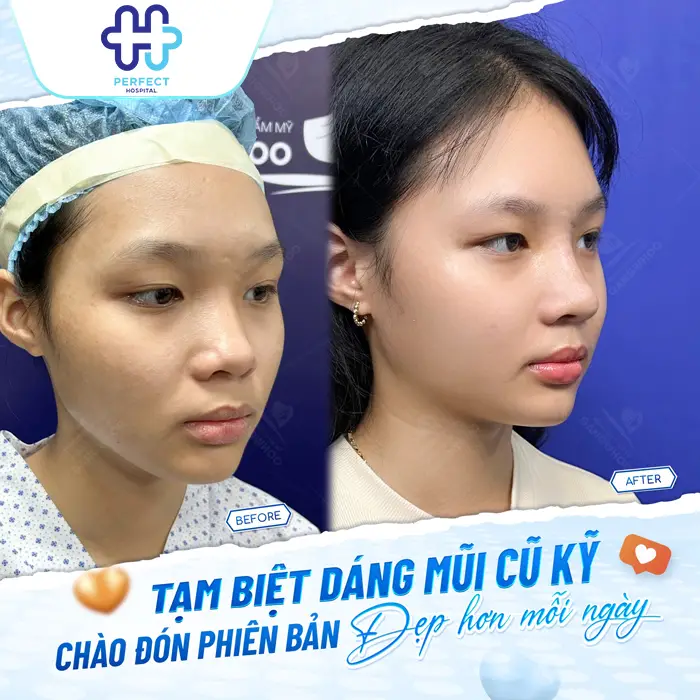 Nâng Mũi Sụn Tự Thân Là Gì? Có Tốt Không Và Quy Trình Ra Sao?