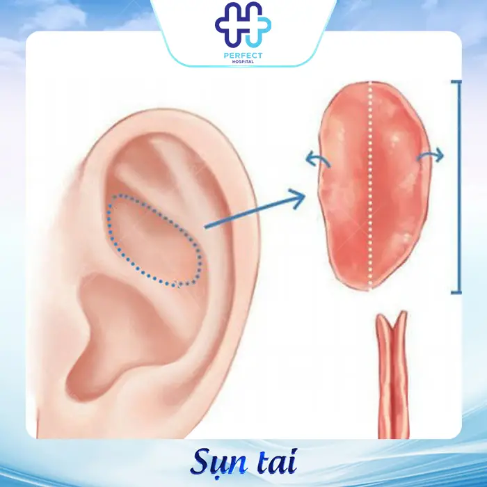 Nâng Mũi Sụn Tự Thân Là Gì? Có Tốt Không Và Quy Trình Ra Sao?