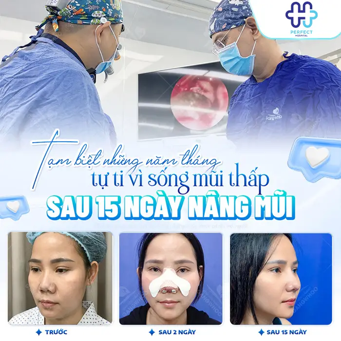 Nâng Mũi Sụn Tự Thân Là Gì? Có Tốt Không Và Quy Trình Ra Sao?
