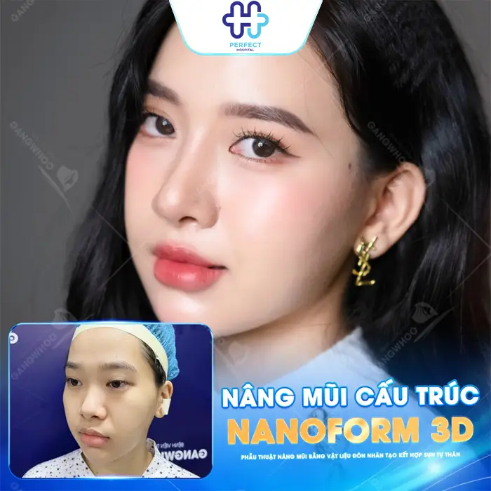 Nâng Mũi Sụn Tự Thân Là Gì? Có Tốt Không Và Quy Trình Ra Sao?